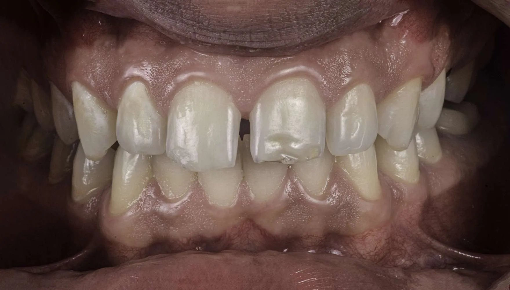 CaseTeethlayers1b_0001_Dr. Sigal Jacobson 1r