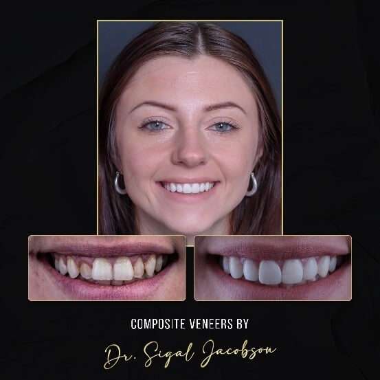 Composite Veneers Melbourne: Before and After Photo