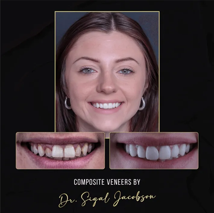 Uveneer Before and after picture | An affordable and less invasive alternative to porcelain veneers