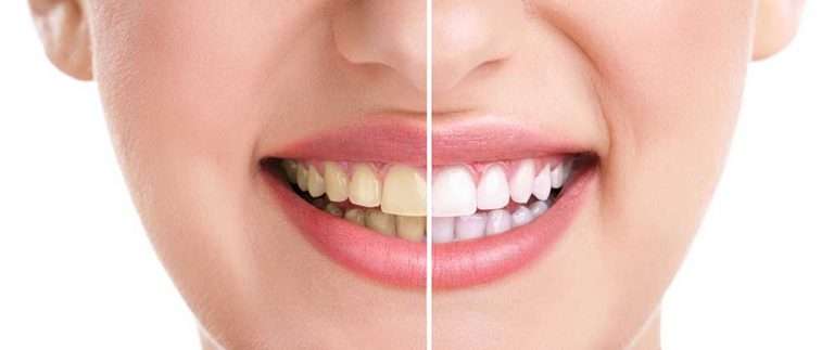 Teeth whiteing for holidays