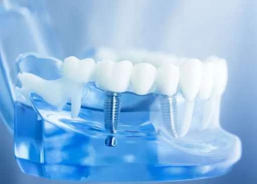 Dental Bridge Vs. Dental Implants – What's Better for My Missing Tooth? | Jacobson Dental Group