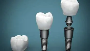 Dental Bridge Vs. Dental Implants – What’s Better for My Missing Tooth?