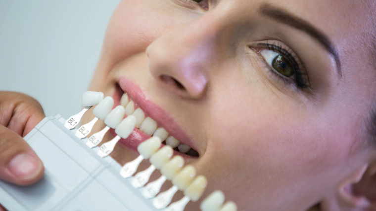 Do Composite Veneers Look Natural?