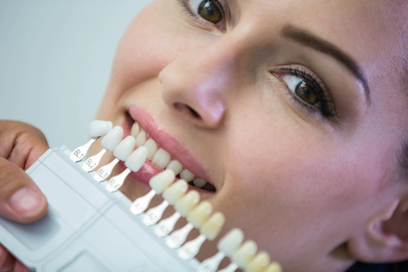 Composite Veneers