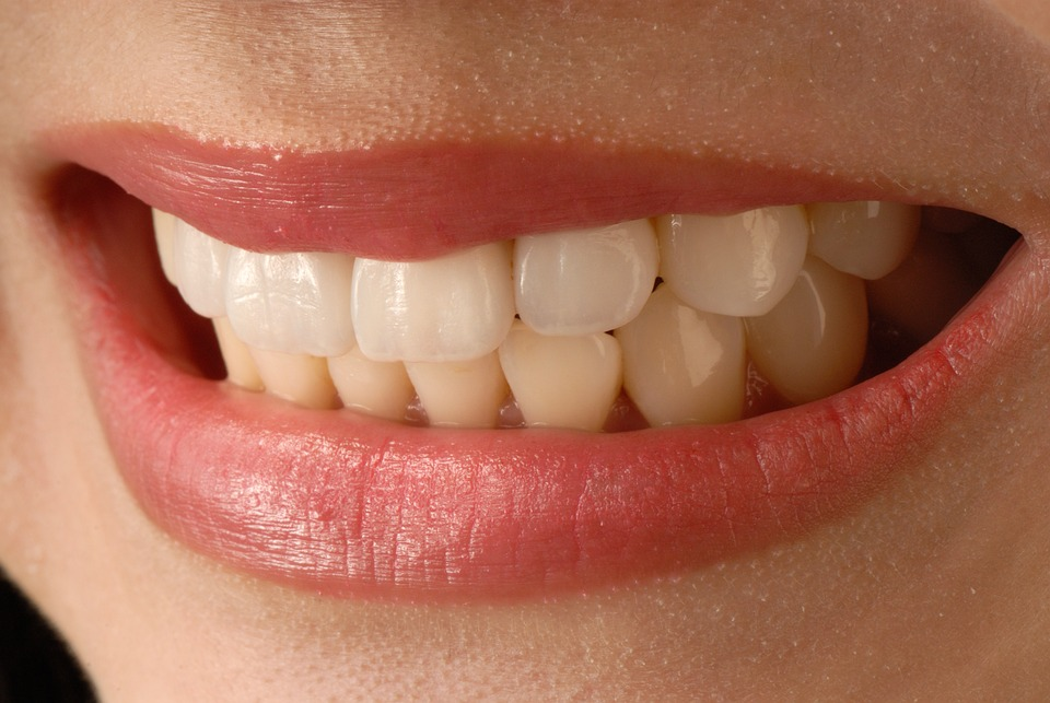 Composite veneers