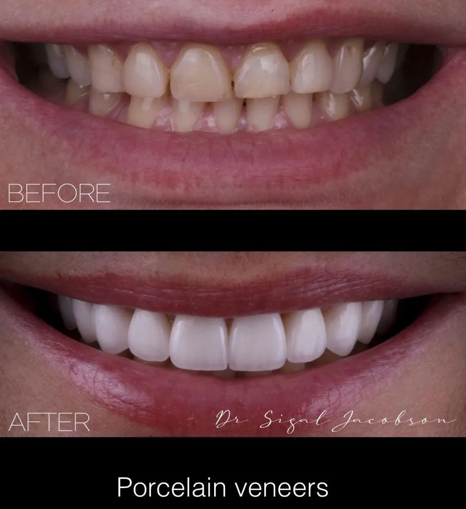 Bentleigh East porcelain veneers