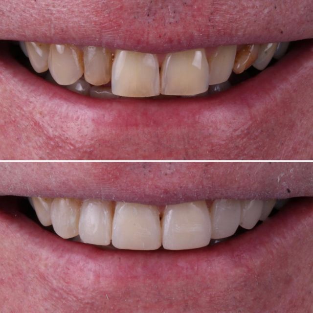 "Today, I had the pleasure of transforming a patient's smile with 6 composite veneers in just two hours! The patient's first words after seeing the result were, 'wow! I wish I would have done it earlier .' It's incredibly rewarding to create a harmonious smile that brings joy and confidence to my patients!
#CompositeVeneers #dentalcrowns #dentalveneersmelbourne #DentalVeneers #SmileTransformation #CosmeticDentistry #HarmoniousSmile #DentalArtistry #SmileMakeover #VeneerJourney #ConfidentSmile #dentalaestheticsberlin