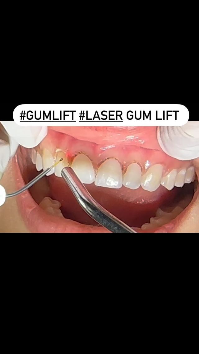 #geminilaser gum lift procedure. 🦷 Discover the Amazing Benefits of Laser Gum Lift! 🌟no injections, no sutures,  minima to no downtime. 
As a dentist, I’m thrilled to offer this amazing treatment that can transform your smile in a minimally invasive way. With a laser gum lift, you can say goodbye to a gummy smile and hello to a beautifully balanced gum line that perfectly showcases your teeth. Experience increased confidence, improved symmetry, and faster healing with this gentle and non-surgical procedure. Ready to transform your smile? Schedule a consultation with our dental team today! ✨🌟💫