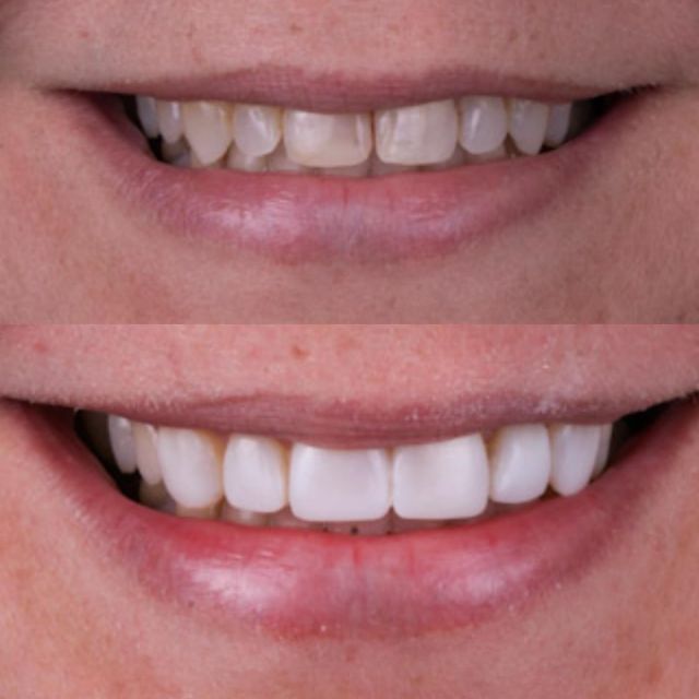 Composite bonded veneers. When you come for an initial consultation we will start by assessing your smile and goals, and most importantly listen to you carefully to your aim then create a unique smile design just for you. Following the smile design rules and the latest composite materials, we'll carefully sculpt and shape each veneer to fit seamlessly into your smile, enhance it perfectly replicating the color of your natural teeth.
Our goal is to provide you with a natural-looking, beautiful smile that boosts your confidence and enhances your overall appearance.
Contact us today to learn more and schedule your consultation!
03-85253875 compositeveneers #uveneer #naturalsmile #smiledesign #paladex #cosmeticdentistrymelbournecbd